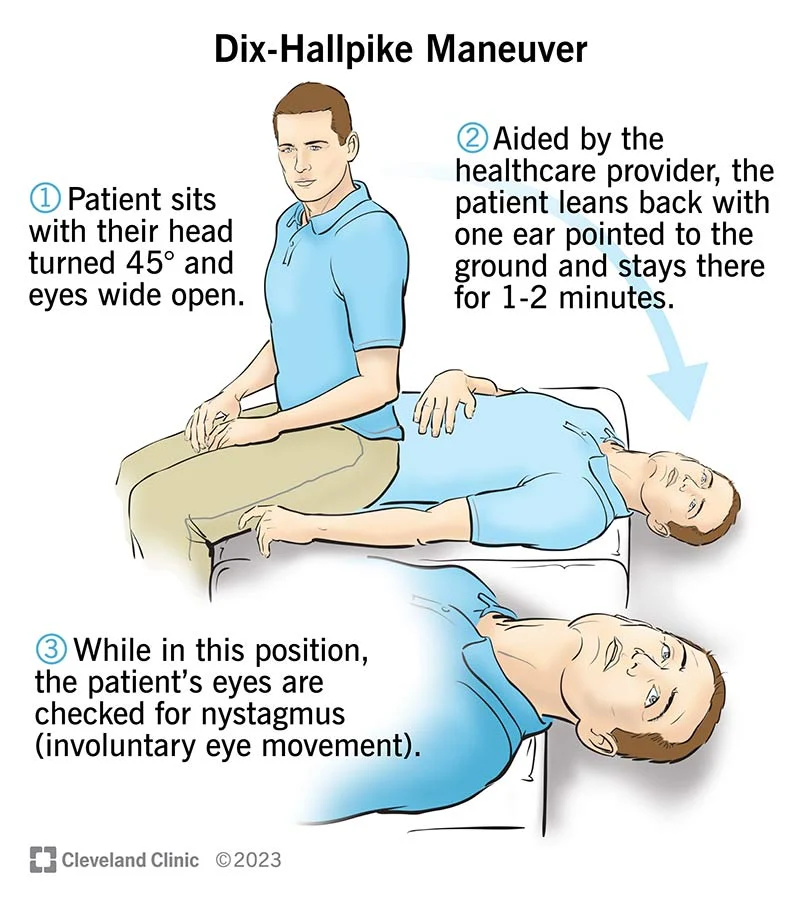 Dix–Hallpike test: - USMLE Gate